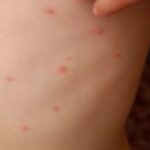 ¿Qué significa soñar con viruelas?